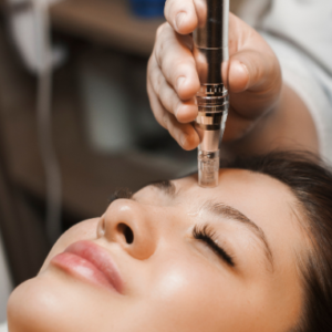 Microneedling - Full Face