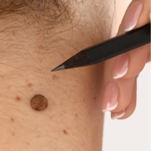 Skin Tags Removal